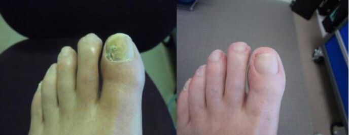 Fotografije stopala prije i nakon korištenja kreme Zenidol