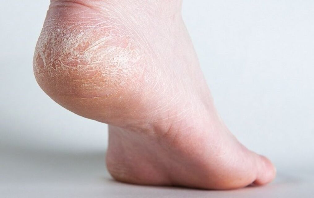 gljivice na koži stopala