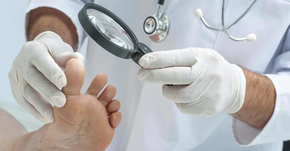 liječnik pregleda stopala s gljivicom