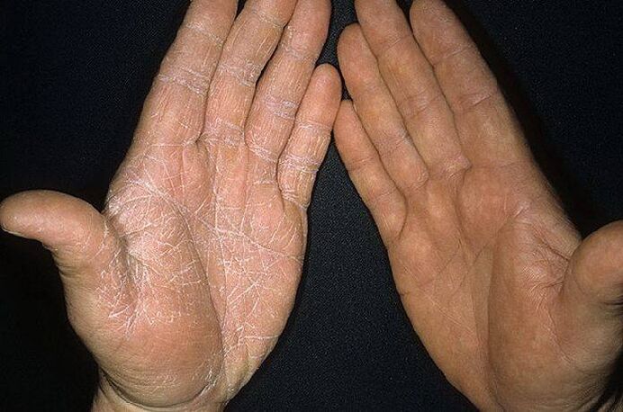 simptomi gljivice na koži ruku
