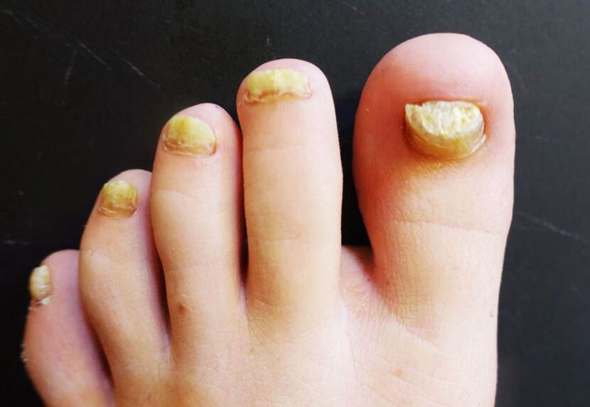 Neugledan izgled noktiju na nogama zahvaćenih gljivicama