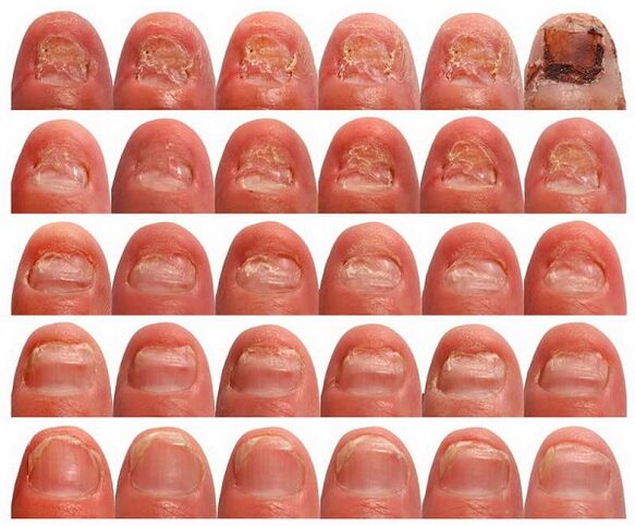 simptomi i manifestacije gljiva na noktima noktiju