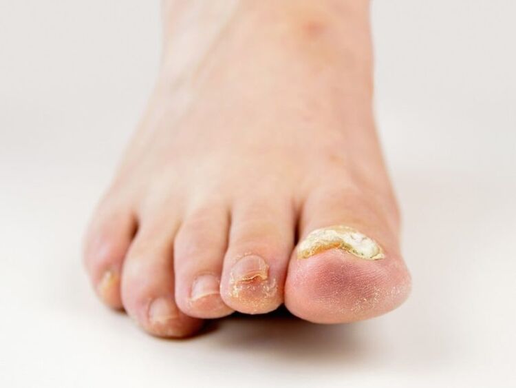 nokti na nogama zahvaćeni gljivicama