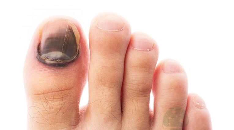 uznapredovali stadij bolesti s gljivicom velikog nokta na nogu
