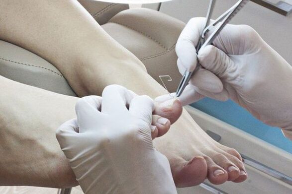 Mehaničko uklanjanje noktiju na nogama zahvaćenim gljivicama