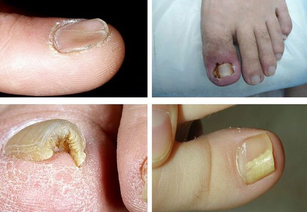 Simptomi onihomikoze na nogama