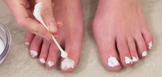 liječenje gljivica na noktima nogu