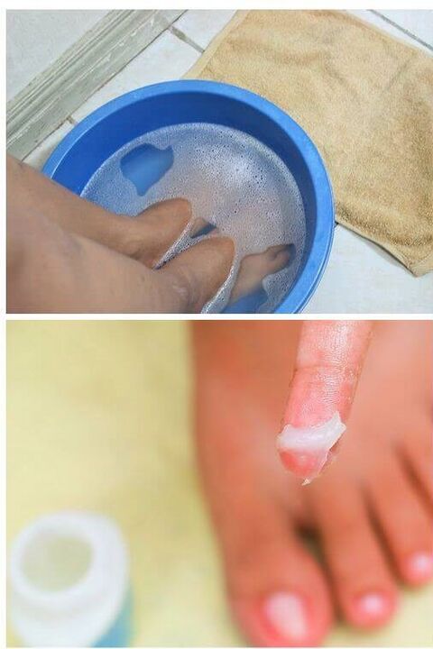 upotreba prirodnih ulja u liječenju gljivica noktiju na nogama