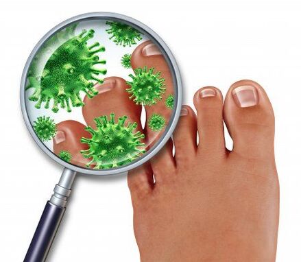 gljivična infekcija na stopalima