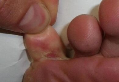 pukotina na nožnom prstu posljedica je gljivične infekcije
